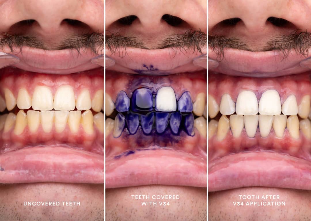 Sérum de Blanchiment Dentaire SMILE™