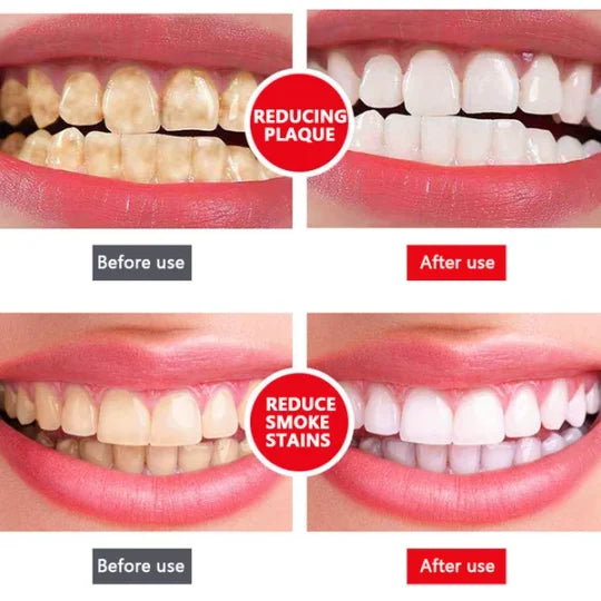 SP-4 Dentifrice Blanchissant Probiotique// Résultat visible après quelques jours d'utilisation